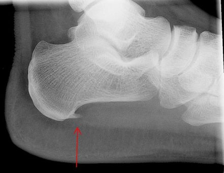 X-Ray of a Plantar Fasciitis