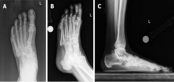 X Ray Arthritic Feet