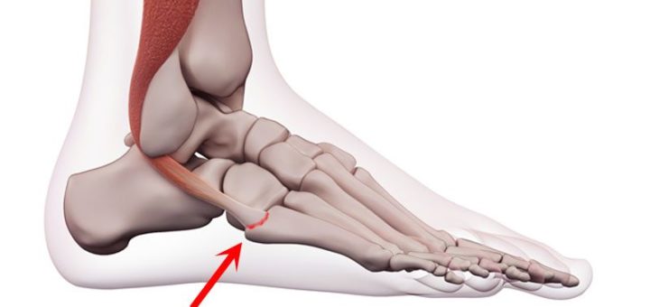 Peroneal Tendonitis Foot Injury