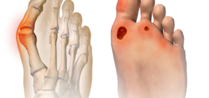 hoka shoes for bunions