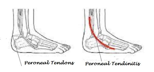 Nike Shoes for Peroneal Tendinitis